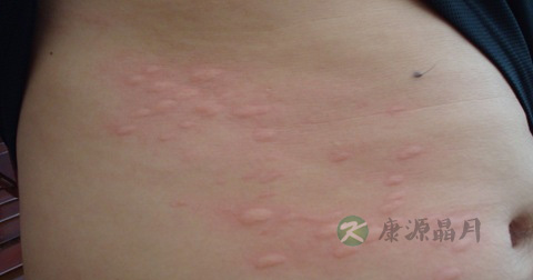 得了麻疹怎么治