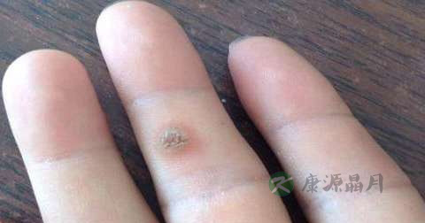 手指上的瘊子怎么去除