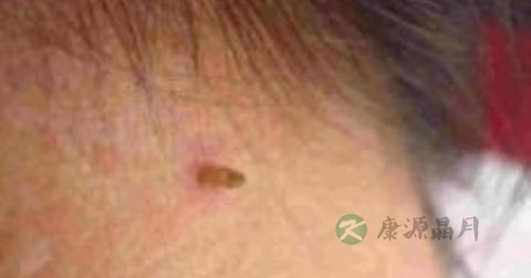 丝状疣怎么治