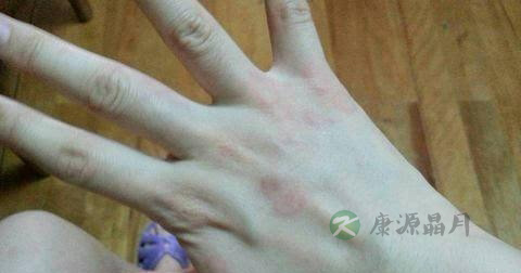 寻马疹是传染病吗