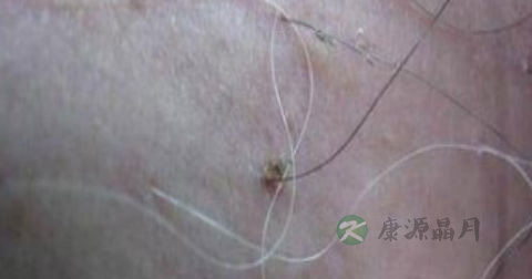 阴虱病有潜伏期吗