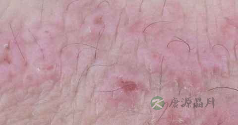 女人性病能治好吗
