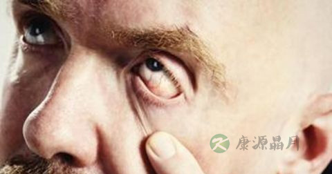 红眼病如何预防