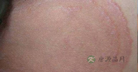 体股癣怎么治