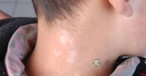 白颠疯是传染病吗