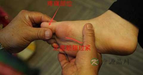 足底筋膜炎的七种治疗方法