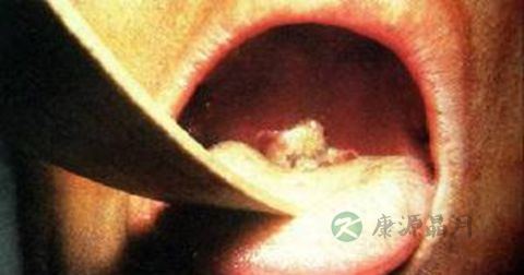 白喉是传染病吗