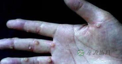 如何去除瘊子