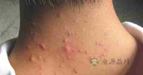 毛囊炎多久洗一次头