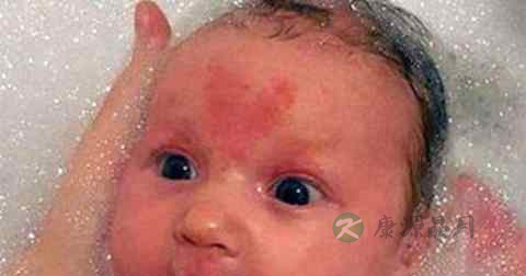 红色胎记治疗方法