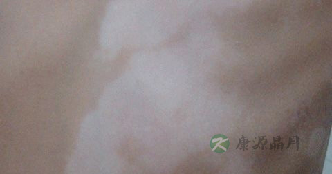 白癜风传播途径
