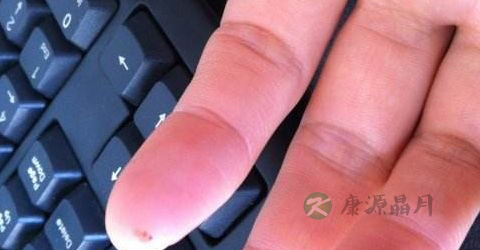 丝状瘊怎么治