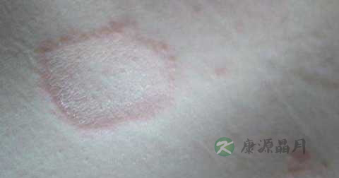 体藓能治好吗