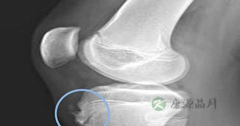膝关节骨膜受损怎么治