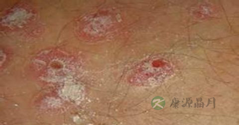 阴虱病的传染途径
