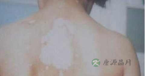 白斑原因