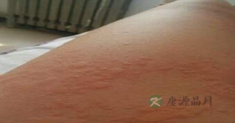 皮炎平可治风团吗