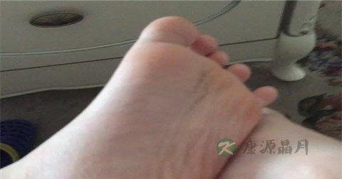 扁平足治疗方法