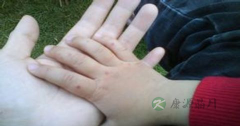 手足口病初期预防方法