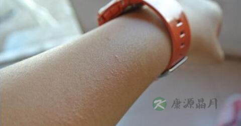 接触性皮炎症状