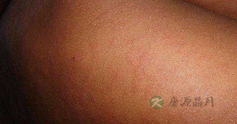 麻疹有可能引起哪些并发症