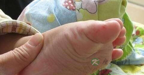 手足口病治疗方法