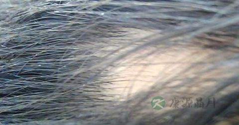 斑秃的治疗