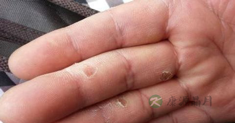 皮炎的治疗