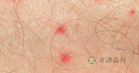二期梅毒怎么治疗