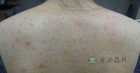 玫瑰藓治疗方法