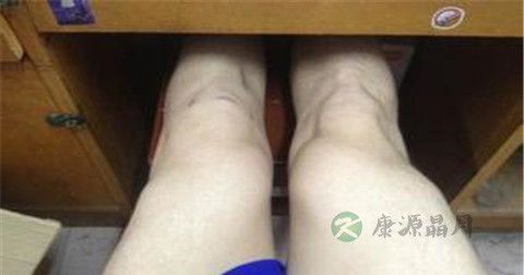 肌肉萎缩怎么治