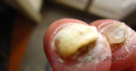 灰指甲前期怎么治疗