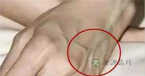 毛细血管堵塞吃什么好