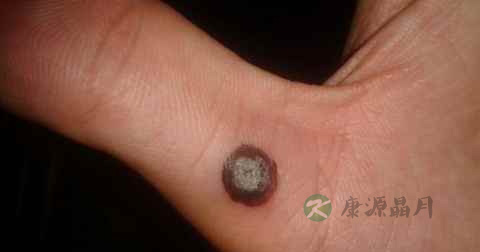 手上长疣怎么治