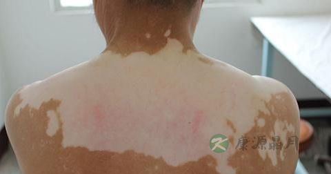 治疗白殿风的方法