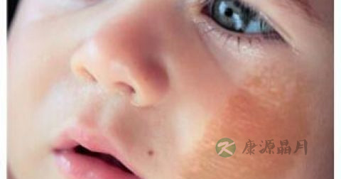 红色胎记怎么治