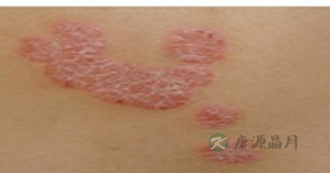 牛皮癣治疗偏方