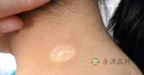 白癜风传染吗