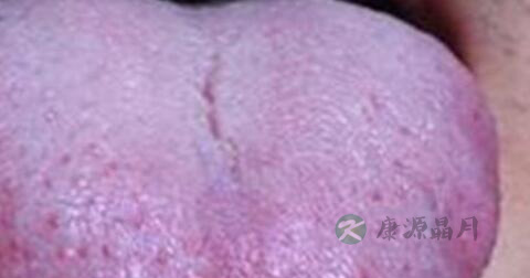 艾滋病红点是什么样子
