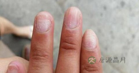 灰指甲前期怎么治疗