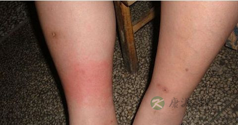 大腿肿是丹毒吗