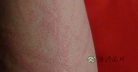 湿疹是遗传病吗