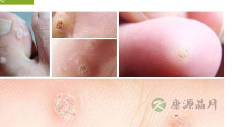 丝状瘊怎么治