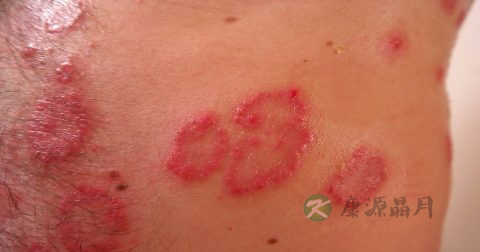 艾滋病的症状