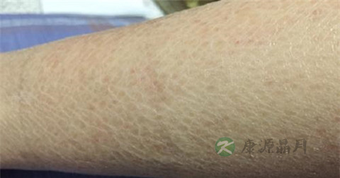 轻微鱼鳞病怎么治