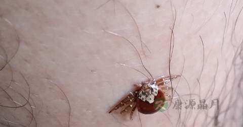蜱虫叮咬后怎么治疗