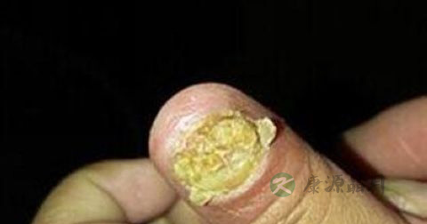 甲沟炎化脓了怎么办