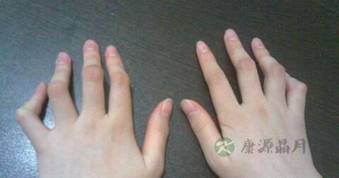 接触性皮炎传染吗