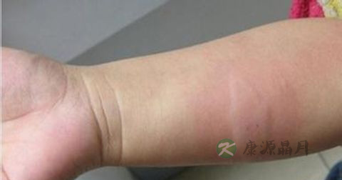 肺吸虫病是传染病吗