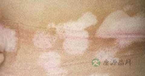 白斑病怎么治疗
